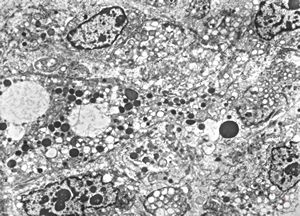 M,58y. | retroperitoneal liposarcoma M,58y. | retroperitoneal liposarcoma